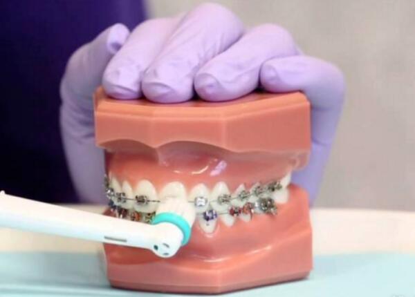 卸了牙套能用電動(dòng)牙刷嗎？答案就在這篇文章